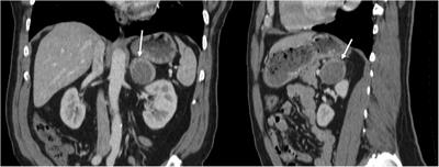 Rare adrenal cavernous hemangioma: a case report highlighting diagnostic challenges